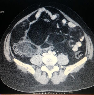 Image of fat density heterogeneous mass measuring 17x13 cm in the iliac fossa at computed tomography.