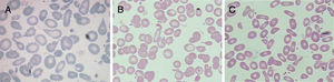 Morphological RBC abnormalities in the blood smear of the patient (A) showing microcytosis with marked poikilocytosis; mother (B) showing microcytosis, mild poikilocytosis and basophilic stippling; and father (C) with increased number of elliptocytes.