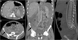 (A–D) Portal phase abdominal CT with intravenous contrast medium showing an apparent laceration in the spleen with a hyperdense subcapsular collection of hematic fluid (white arrow), a large hemoperitoneum on the left side (double headed white arrow), continued retroperitoneal collection in the right iliac fossa (black arrow) and a mild to moderate pleural effusion on the right side (*), as well as the previously described bone alterations (white circle).