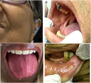 Extra and intraoral features observed in individuals with multiple myeloma. (A) Swelling in the preauricular area (arrows); (B) pale mucosa; (C) depapillation of the tongue; (D) traumatic ulcer in individual with facial palsy.