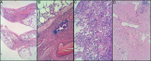 CT-Guided Tru-Cut. A) interstitial fibrosis with mainly peribronchiolar distribution, but no fibroblastic foci observed. B) mild interstitial chronic inflammation. Lymphocytic infiltrates without atypia. No intraluminal organizing fibrosis in these samples. Cryobiopsy in right upper lobe. C) mild interstitial chronic inflammation. No atypical cells suspicious for malignancy were observed, either lymphoid or epithelial. D) pulmonary fibrosis with complete remodeling of lung architecture in one of three fragments. Elastosis and amyloidosis were ruled out.