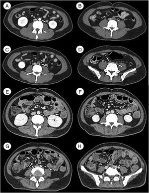 A–D Angiotomography on admission. A) L3. Permeable abdominal aorta. B and C) L4. An arterial thrombus that occludes the distal end of the abdominal aorta. D) L5. The arterial thrombus that occludes both common iliac arteries. E–H Angiotomography after treatment. E) L2. Permeable abdominal aorta. F) L3. The arterial thrombus that partially occludes the abdominal aorta. G and H) L4-L5. The arterial thrombus that occludes only the right iliac artery.