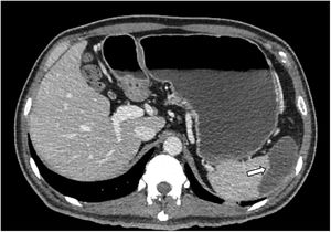 Computerized axial tomography with contrast. Splenic infarction of the upper pole.