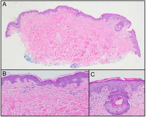 (A) Scanning magnification reveals a punch biopsy specimen with a very mild superficial perivascular infiltrate. A follicle is present with a mild perifollicular lymphocytic infiltrate with overlying parakeratosis (20× magnification, H&E). (B) Higher magnification of the scant superficial perivascular lymphocytic infiltrate. Eosinophils were not identified (H&E, 100× magnification). (C) Higher magnification of the mild perifollicular lymphocytic infiltrate with overlying parakeratosis and mild follicular spongiosis. The Periodic Acid Schiff (PAS) stain was negative (H&E, 100× magnification).