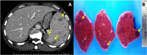 (A) Contrast-enhanced abdominal computed tomography scan (axial view), revealing multiple hypoattenuating nodules in spleen (arrows). (B) Cut surfaces of resected spleen showing multiple dark-red nodules (arrows) and splenomegaly (weight 619g).