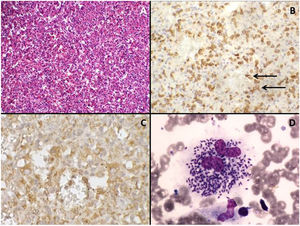 (A) The nodules are a disorganized red-pulp-like proliferation without lymph follicle atypia, mitosis, or necrosis. Hematoxylin-eosin stain, 200× magnification. (B) Sinusoids within the nodules are partly lined with CD8+ cells (arrows), 200× magnification. (C) Red-pulp-like nodule with CD68+ cells both dispersed as well as partly lining the sinusoids (histiocyte-rich splenic hamartoma), 400× magnification. (D) Numerous amastigotes forms of Leishmania ssp. in the cytoplasm of macrophages in bone marrow smear. Leishman staining, 1000× magnification.