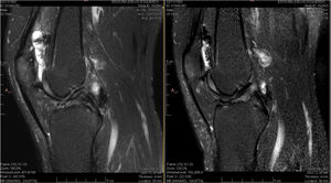 Magnetic resonance imaging of a 33-year-old patient with haemophilic arthropathy of the knee. The T2-weighted SPIR (Spectral Presaturation with Inversion Recovery) image shows highly enhanced joint effusion. The hypertrophic synovium with black hemosiderin deposits is irregular with variable composition and different thicknesses along the articular surface (arrows). Adjacent soft tissues appear light grey (left). Magnetic resonance imaging obtained six months after treatment shows that the size of the synovium (arrow) and extent of joint effusion have both been reduced (right).