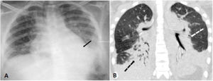 Panel A (chest radiograph): bilateral inferior consolidations. Panel B (coronal chest CT): inferior and peri bronchial atelectasis and consolidations on both lungs predominantly on posterior zones.
