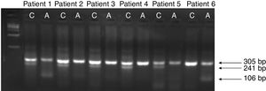 Allele-specific polymerase chain reaction (AS-PCR) for HMIP1 C-839A (rs9376092). The AS-PCR products were subjected to gel electrophoresis in 1.5% agarose. Lane 1 shows 1kb DNA-ladder (Invitrogen, Carlsbad, CA, USA). The pattern for the ancestral allele C (241bp) is present in lanes 2, 4, 6, 8 and 10. Lanes 3 and 13 exhibit the pattern for the variant allele A (106bp). The reaction internal control (305bp) is visualized in lanes 2–13. Patients 2, 3, 4 and 5 are homozygous for the CC genotype, while patients 1 and 6 present the CA and AA genotypes, respectively.