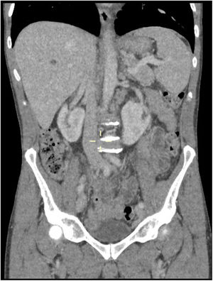 CT chest, abdomen and pelvis; shows multiple enlarged lymph nodes likely pathological consistent with axillary and mediastinal and to a slightly lesser extent hilar lymphadenopathy. Paratracheal and subcarinal nodes measures 15mm in short-axis diameter. Right hilar and periesophageal nodes measures 14mm in diameter, left hilar and periesophageal measures 12mm in short-axis. Few mildly enlarged common femoral/external iliac lymph nodes bilaterally. Measuring at the short axis 17mm with an oval shape. Multiple retroperitoneal para-aortic, paracaval into aortocaval lymph nodes noted, measuring at the short axis between 10 and 14mm. There is also loss of definition around the portal confluence due to multiple periportal lymph nodes. Spleen is enlarged in the short axis at 8cm.