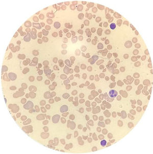 Peripheral blood smear showing schistocytes, suggesting the presence of microangiopathic thrombosis.