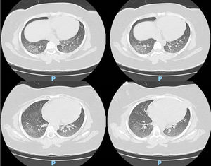 Chest computed tomography showing bilateral ground-glass opacities distributed in pulmonary parenchyma, suggesting viral pneumonia.