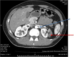 Angio-CT scan showing thrombosis of the left renal artery (blue arrow) and left kidney infarct (red arrow) after two months of anticoagulation.