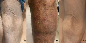 After receiving brentuximab, the patient persisted with refractory mycosis fungoides/ Sezary syndrome involving the skin, with mild cracking and fissuring (a). He underwent outpatient-haploidentical hematopoietic cell transplantation. On day +27 the patient developed erythematous pruritic cutaneous lesions on his lower extremities and a skin biopsy confirmed acute graft‐versus‐host disease (GvHD) which later progressed to steroid-refractory GvHD (b). The patient received rituximab successfully from day +153 to +187; he completed the transplant entirely as an outpatient, remained in complete remission and showed no further evidence of GvHD at eleven months after haploidentical cell transplantation (c).