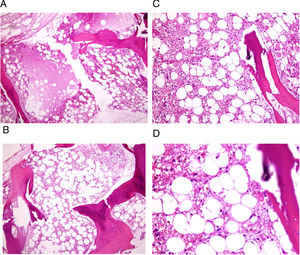 (A–D) Bone marrow biopsy of a patient with bone marrow necrosis showed disturbed marrow architecture, with diffuse bone marrow necrosis, cells revealing coagulative necrosis, with loss of normal staining, cells are embedded in an amorphous eosinophilic background. Stained by Hematoxylin & Eosin.