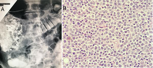 (A) ERCP shows a calcified duodenal mass associated with strictures and fibrosis. (B) Duodenal tissue histology shows monomorphic medium-sized lymphocytes with abundant pale cytoplasm, containing round nuclei and exhibiting epitheliotropism.