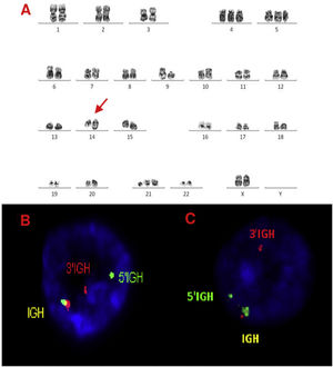 A, B and C–Cytogenetic studies from case 1: (1A) Lymph node karyotype analysis with G-banding demonstrating complex karyotype, the arrow shows additional material in 14q, (1B) interphase break-apart FISH showing IGH rearrangement, with separation of the 5′-probe (green) from the 3′-probe (red) in paraffin-embedded tissue and (1C) in suspension cells.