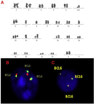 A, B and C–Cytogenetic studies from case 2: (2A) Lymph node karyotype analysis with G-banding demonstrating complex karyotype, (2B) interphase break-apart FISH showing extra copy of BCL6 (3 fusion signals) detected in paraffin-embedded tissue and (2C) in suspension cells.