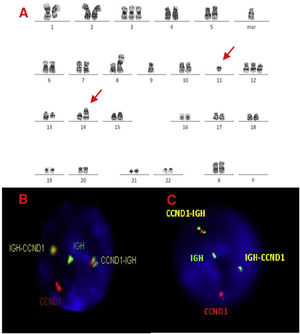 A, B and C–Cytogenetic studies from case 3: (3A) Lymph node karyotype analysis with G-banding demonstrating complex karyotype, the arrows shows t(11;14), (3B) interphase dual color, dual fusion FISH showing CCND1-IGH rearrangement, with 2 fusion signals detected in paraffin-embedded tissue and (3C) in suspension cells.