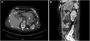 (A) Pneumoperitoneum (yellow arrow), gastric pneumatosis (red arrow). (B) Pneumoperitoneum (yellow), gastric pneumatosis (red), stomach edema (green), left renal infarct (purple).