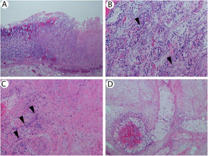 (A) Stomach with ulcer and fungi (hematoxylin & eosin, 40×). (B) Ulcerated and necrotic mucosa with ribbon-like fungal forms consistent with mucormycosis (arrowheads; hematoxylin & eosin, 200×). (C) Stomach wall showing fungi within muscularis propria (arrowheads; hematoxylin & eosin, 200×). (D) Necrotic vessel in stomach wall containing fungi.
