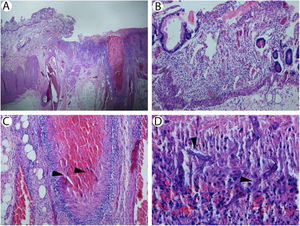 (A) Small bowel with ulcer centered on large vessel (hematoxylin & eosin, 40×). (B) Non-ulcerated small bowel mucosa showing crypt dropout but no significant apoptotic activity consistent with prior episode of graft versus host disease (hematoxylin & eosin, 200×). (C) Artery in small bowel wall containing fungi consistent with mucormycosis (arrowheads; hematoxylin & eosin, 200×). (D) Necrotic small bowel mucosa with fungi consistent with mucormycosis (arrowheads; hematoxylin & eosin, 400×).