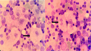 Gaucher cells observed in the spreading of medullary material obtained by means of Bone Marrow Aspirate (100×).