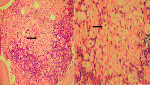 (A) Bone marrow biopsy showing massive infiltration by Gaucher cells, surrounded by residual hematopoietic tissue. (B) Gaucher cells in bone marrow biopsy.