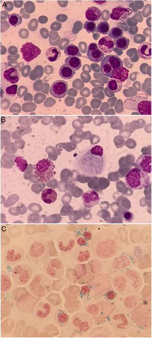 (A) Bone marrow aspirate showing several erythroblasts displaying dyserythropoietic features (May Grunwald Giemsa stain, 1000×). (B) Atypical macrophage showing Gaucher-like cell morphology (May Grunwald Giemsa stain, 1000×). (C) Iron stain of bone marrow aspirate showing numerous ring sideroblasts (Iron stain, 1000×).