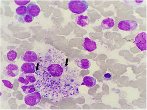 BM aspirate: numerous yeast-like bodies inside macrophages (arrows) with morphology suggestive of Histoplasma spp.