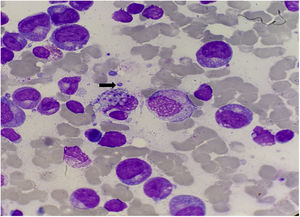 BM aspirate: yeast-like bodies outside macrophages (arrow) with morphology suggestive of Histoplasma spp.