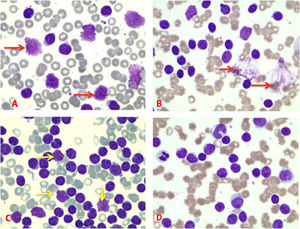 Blood smears of different CLL patients (x 100). A and B: different forms of SC (red arrows). C: SC with disrupted nuclear membrane (yellow arrows). D: Blood smear without SC. * represent the degree of significance. *: p = 0.01, **: p = 0.001, ***: p = 0.0001.Ns = not significant.