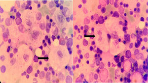 Gaucher cells observed in the spreading of medullary material obtained by means of Bone Marrow Aspirate (100×).