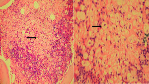 (A) Bone marrow biopsy showing massive infiltration by Gaucher cells, surrounded by residual hematopoietic tissue. (B) Gaucher cells in bone marrow biopsy.