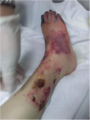 Ischemic right lower limb with necrotic areas in the toe.