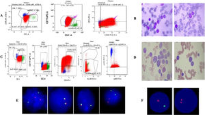 Salient features of the immunophenotype, at diagnosis: (A) blasts (red) co-express CD19/CD34 and CD38 antigens, whereas they do not express CD10, CD20, CD33 or CD117 antigens. The expressions of other myeolid and lymphoid antigens of the T lineage was not detected. (B) Bone marrow aspiration images at diagnosis. Salient features of the immunophenotype, at relapse: (C) blasts (red) now co-express CD36/CD64/Cy MPO and CD117 while they do not express the CD19 antigen. Color indicators: red color – blasts, green – granulocytes, blue – lymphocytes, and violet – monocytes. (D) Bone marrow aspiration images at relapse. (E) FISH study at diagnosis (left to right): interphase cell showing 2 orange, 2 green signals indicating BCR/ABL: Ph negative status. Signal pattern showing 2 fusion (yellow) signals indicative of negative status for E2A gene rearrangement/translocation. Signal pattern showing 2 fusion (yellow) signals indicative of negative status for MLL; t(11q23) gene rearrangement/translocation. Interphase cell showing 2 orange, 2 green signals indicating TEL/AML1 ES: t(12;21) (p13;q22):negative status. (F) FISH study at replapse: on the left – cell showing one orange and one green signals, indicating positive for loss of chromosome 17p13, locus (90%), nuc ish (TP53, NF1)×1[180/200]; on the right – cell showing two orange signals, indicating negative for deletion of the 20q12 locus, nuc ish (D20S108×3) [20/200].