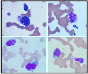 Marrow aspirate showing pleomorphic plasma cells with basophilic cytoplasm and multilobated nuclei. Background RBCs show rouleau.