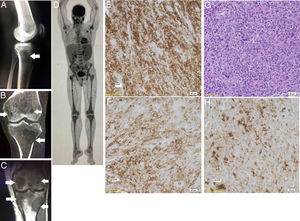 (A) Radiography of the left knee showing a lytic lesion in the proximal tibia (white arrow). (B) CT of the left knee in the coronal section demonstrating multiple osteolytic images in the distal femur and proximal tibia, with a defect of the cortical of the lateral tibia metaphysis (white arrows). (C) MRI of the left knee in the coronal section in T1-weighted image sequence demonstrates a heterogeneous pattern of bone marrow with focal areas of sparse low signal, some with nodular aspect (white arrows). (D) PET-CT showing an important axial and appendicular skeleton metabolic activity along with a T5-L2 vertebrae lesion. Spleen, cervical, and axillary lymph nodes, also, shows metabolic activity. (E) Anatomopathological evaluation (40×) reports immunohistochemical positivity to CD43. (F) Anatomopathological evaluation (40×) reports immunohistochemical positivity to CD45 (leukocyte antigen). (G) Anatomopathological evaluation (hematoxylin and eosin; 40×) reports the proliferation of large cells, with blastoid characteristics. (H) Anatomopathological evaluation (40×) reports partial immunohistochemistry positivity to the lysozyme marker, of granular cytoplasmic pattern, compatible with myeloid origin.