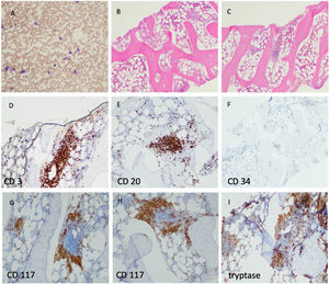 Bone marrow aspirate and trephine biopsy show the infiltration of a CD117 and tryptase positive mast cell infiltrate admixed with lymphocytes.