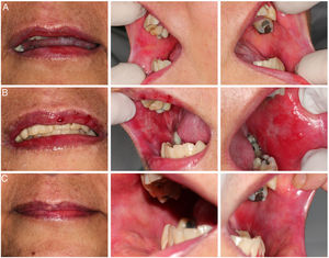 Clinical images: Line “A” baseline images showing classic cGVHD lesions; Line “B” clinical condition in acute complication of the oral mucosa; Line “C” D + 4 of treatment for Mycoplasma with doxycycline.