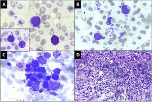 A: Peripheral blood smear showing a blast and a basophil. Red Blood cells in the background show moderate anisopoikilocytosis. Inset: A dysplastic hypersegmented neutrophil along with a blast (×1000, Giemsa), B: Blasts with cytoplasmic blebs and megakaryocytic fragments, (×1000, Giemsa) C: Bone marrow aspirate smear showing a cluster of dysplastic megakaryocytes and blasts (×1000, Giemsa), D: Trephine biopsy showing streaming and clusters of dysplastic megakaryocytes and megakaryoblasts (×400, Hematoxylin & eosin).