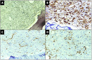 A: Grade III fibrosis on trephine biopsy (×400, Reticulin), B: Immunohistochemistry with CD61 showing diffuse expression in the megakaryocytes and megakaryoblasts, C: CD34 negative in the blasts and D: MPO expressed in the scattered myeloid cells but negative in blasts (×400, DAB).