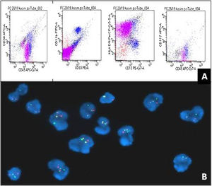 A: Gated population of blasts cells (pink) are positive for CD45, CD13 and HLA-DR and negative for CD34, CD117 and CD33, B: Fluorescence in situ Hybridisation using dual colour probes for BCR (green) and ABL (red) demonstrating dual fusion signals for Philadelphia chromosome (Yellow).