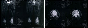 MRI with coronal and axial sections, both in Fast-SE—short time inversion recovery (FSE Stir), showing bone lesions with a high degree of proliferation in the distal third of both femurs.