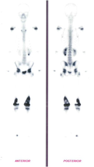 Bone Scintigraphy with a high degree of osteoblastic activity in distal third of femurs.