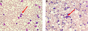 (A) Peripheral blood film (stained with Wright-Giemsa) demonstrates lymphocytosis with some lymphocytes exhibiting multilobulated appearance resembling flower-like appearance (red arrow). (B) Bone marrow aspiration (stained with May-Grunwald-Giemsa) is hypercellular for age and shows lymphocytosis with some lymphocytes exhibiting abnormal morphology (red arrow).