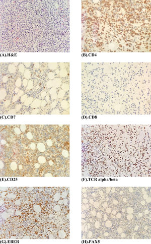 (A) Bone marrow trephine biopsy H & E stain (×40 magnification) shows a hypercellular marrow with diffuse infiltration by large clusters of abnormal lymphocytes. (B–F) Immunohistochemistry panel, Dako, Denmark (×40 magnifications) shows tumour cells staining positive for CD4, CD25 and TCR- alpha/beta and EBER. Tumour cells stain negative for CD7, CD8 and PAX5.