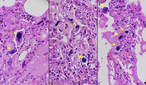 Multiple megakaryocytes (arrows) identified in the pulmonary circulation (Hematoxylin and Eosin staining, 400 × magnification).