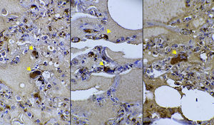 Immunohistochemistry analysis for confirmation of megakaryocytes (arrows) in lungs. Factor VIII-related antigen stain. CD61 immunohistochemistry was also positive on megakaryocytes (not shown). 400 × magnification.