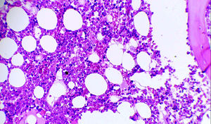 Bone marrow biopsy shows normal global cellularity (granulocytic hypoplasia and erythroid hyperplasia) and normal megakaryocyte cellularity (2.8 megakaryocytes per high-power field [× 400] – normal range 2 to 4 per high-power field). There is no evidence of cancer infiltration, granulomas, or mycoses (Hematoxylin and Eosin staining, 200 × magnification).